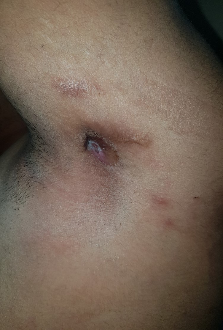 Scrofuloderma | Knowledge Base